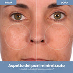 Trattamento di Microdermoabrasione