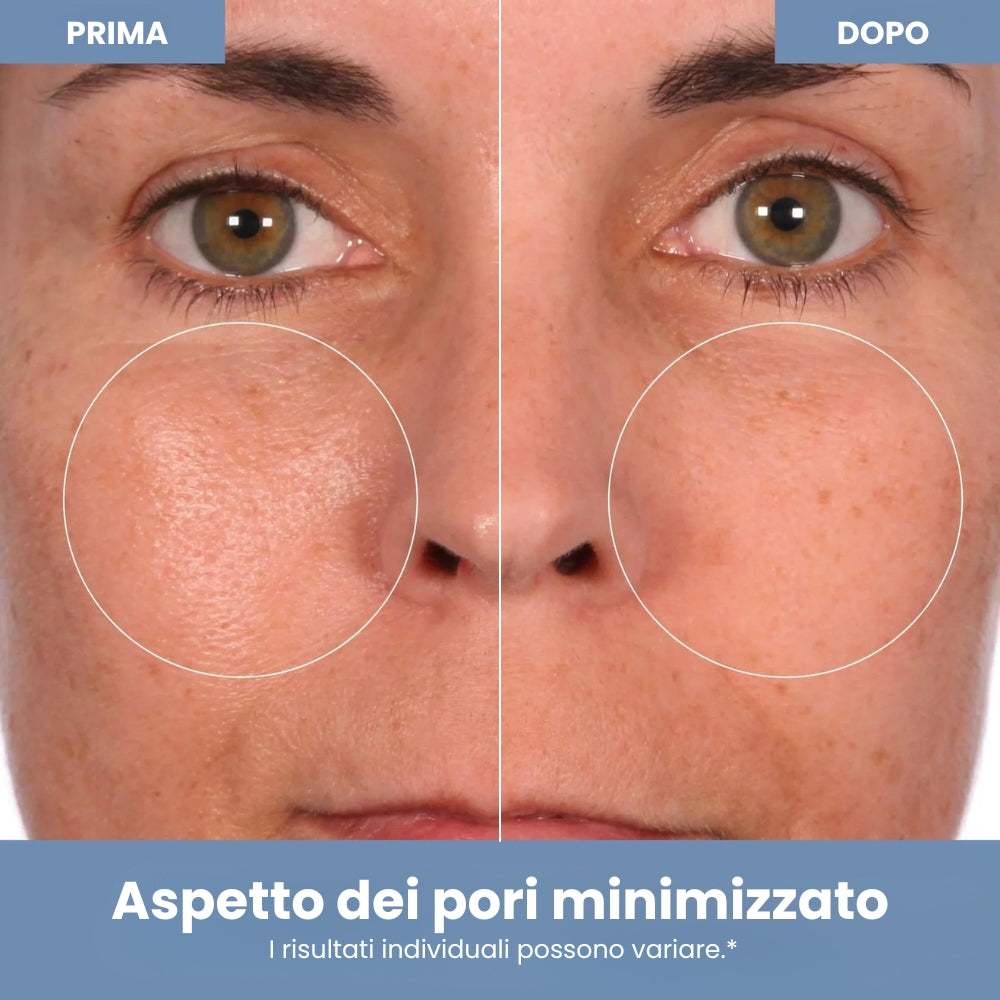 Trattamento di Microdermoabrasione